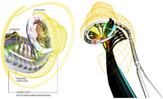 Điện cực cấy bên trong ốc tai