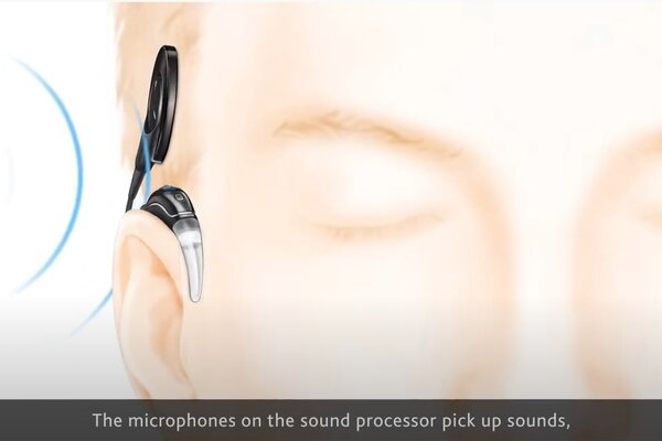 Ốc tai điện tử Cochlear hoạt động như thế nào?